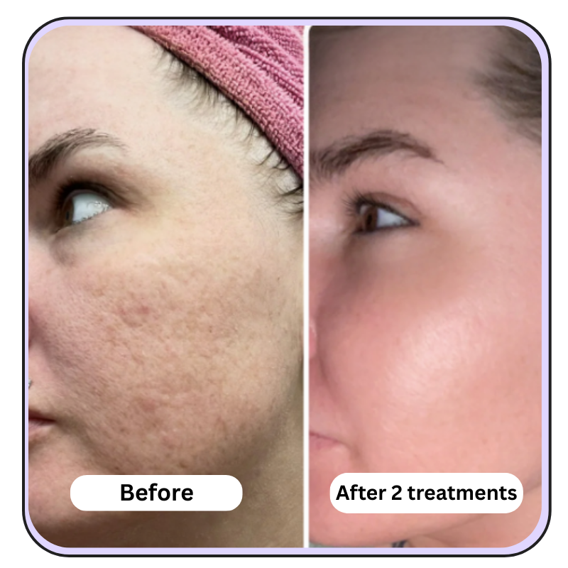 Extra Strength- Anti-Aging Micro Infusion Kit