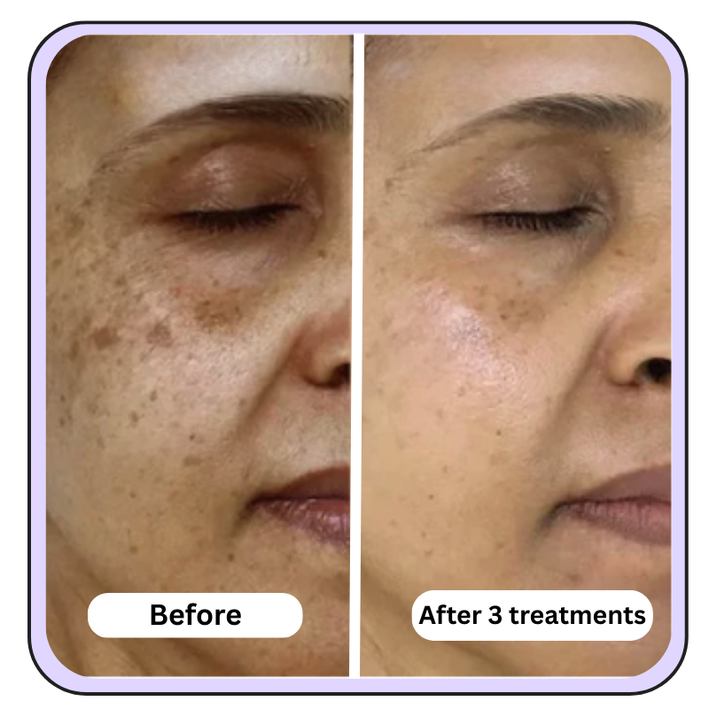 Extra Strength- Anti-Aging Micro Infusion Kit