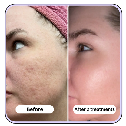 Extra Strength- Anti-Aging Micro Infusion Kit