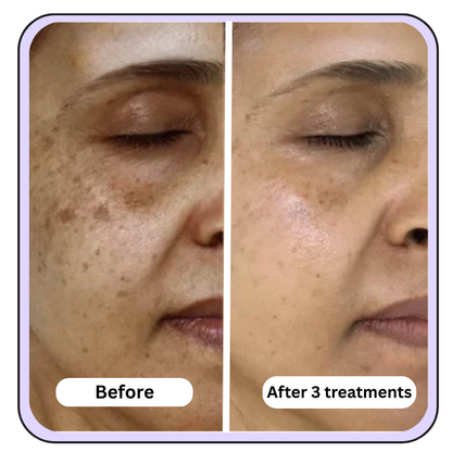 Extra Strength- Anti-Aging Micro Infusion Kit