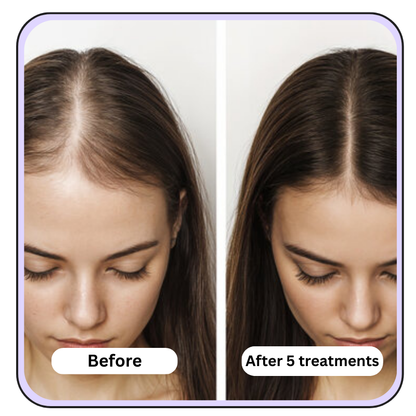 Extra Strength- Anti-Aging Micro Infusion Kit
